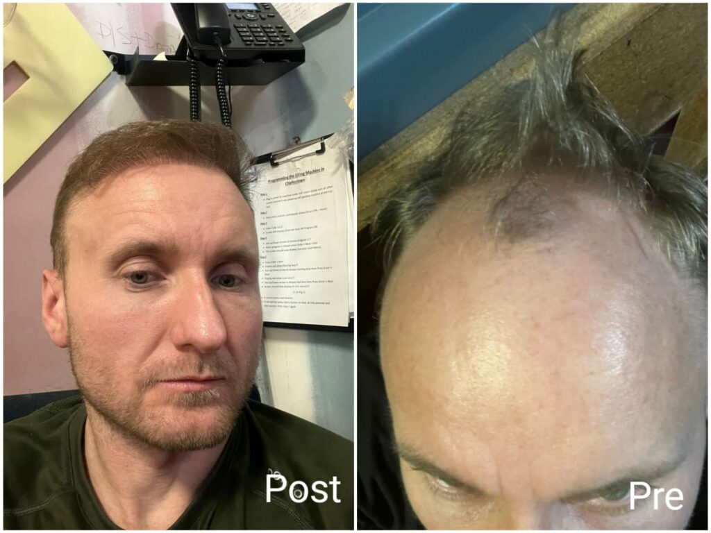 زراعة الشعر في مصر